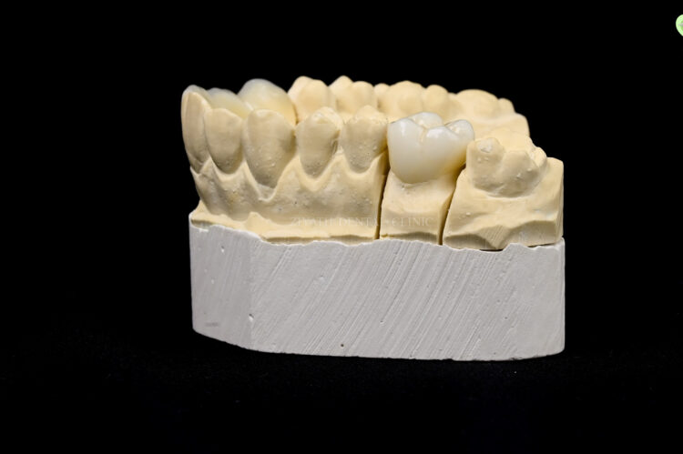 Aesthetic zirconia and porcelain prosthodontic dental crown
