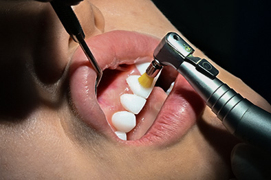 Professional dental teeth cleaning, scaling and stain removal session