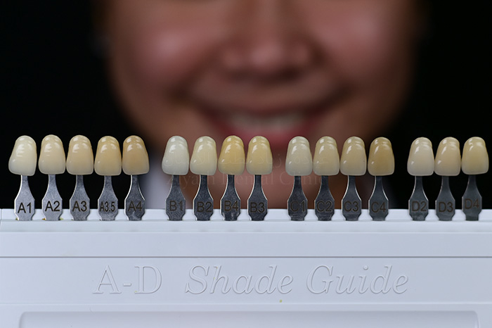 Hollywood Smile cosmetic makeover and porcelain dental veneers at ZDMC Dubai
