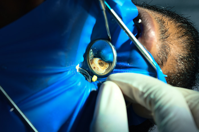 Pain-free root canal endodontic therapy with digital radiography at ZDMC