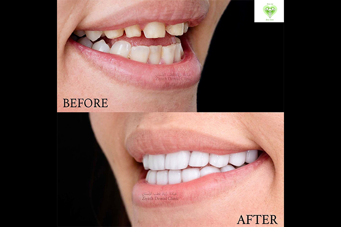 Aesthetic tooth-colored composite dental filling restoration